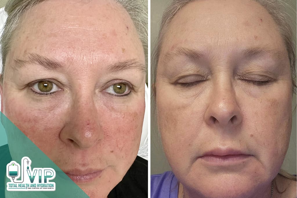 Collagen Induction Therapy: Unlock Radiant Skin with Morpheus8 Microneedling